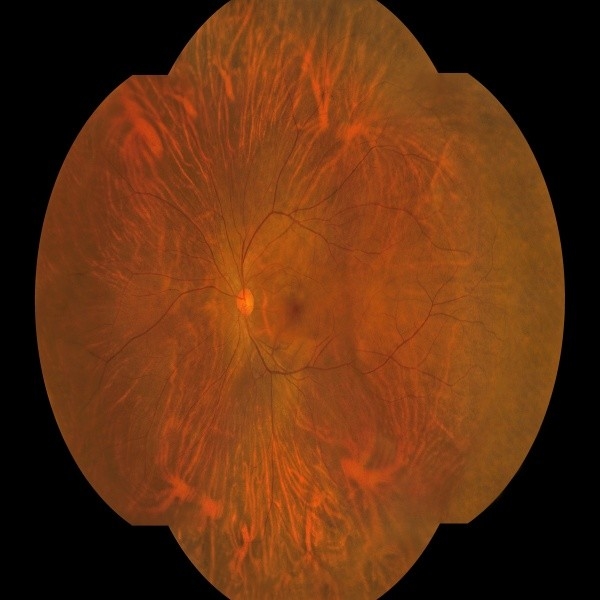 Cámara de fondo de campo amplio de captura binocular automática con una sola llave para dispositivos médicos oftalmológicos